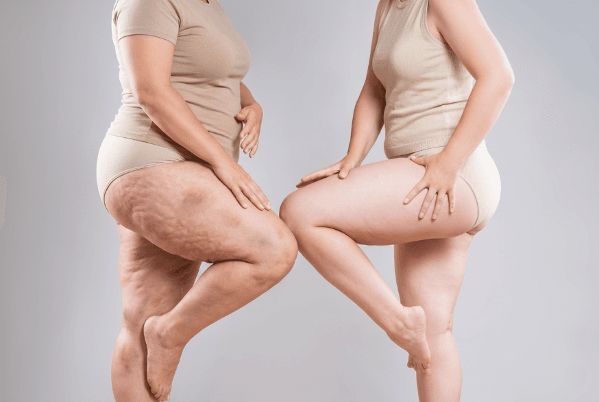 Lipödemde İnflamasyonu Azaltan Yaşam Tarzı: Diyetisyenden Bilimsel Rehber